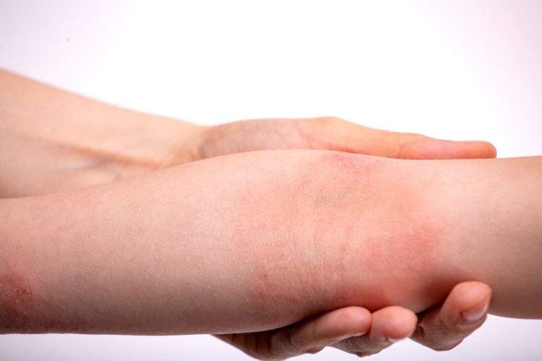 Lee más sobre el artículo Tratamiento dermatitis en Santander: atención médica personalizada para tu piel