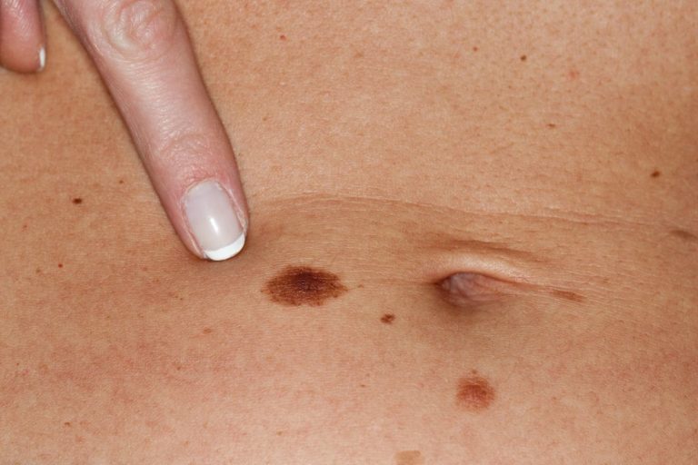 Lee más sobre el artículo Quitar cáncer de piel en Cantabria