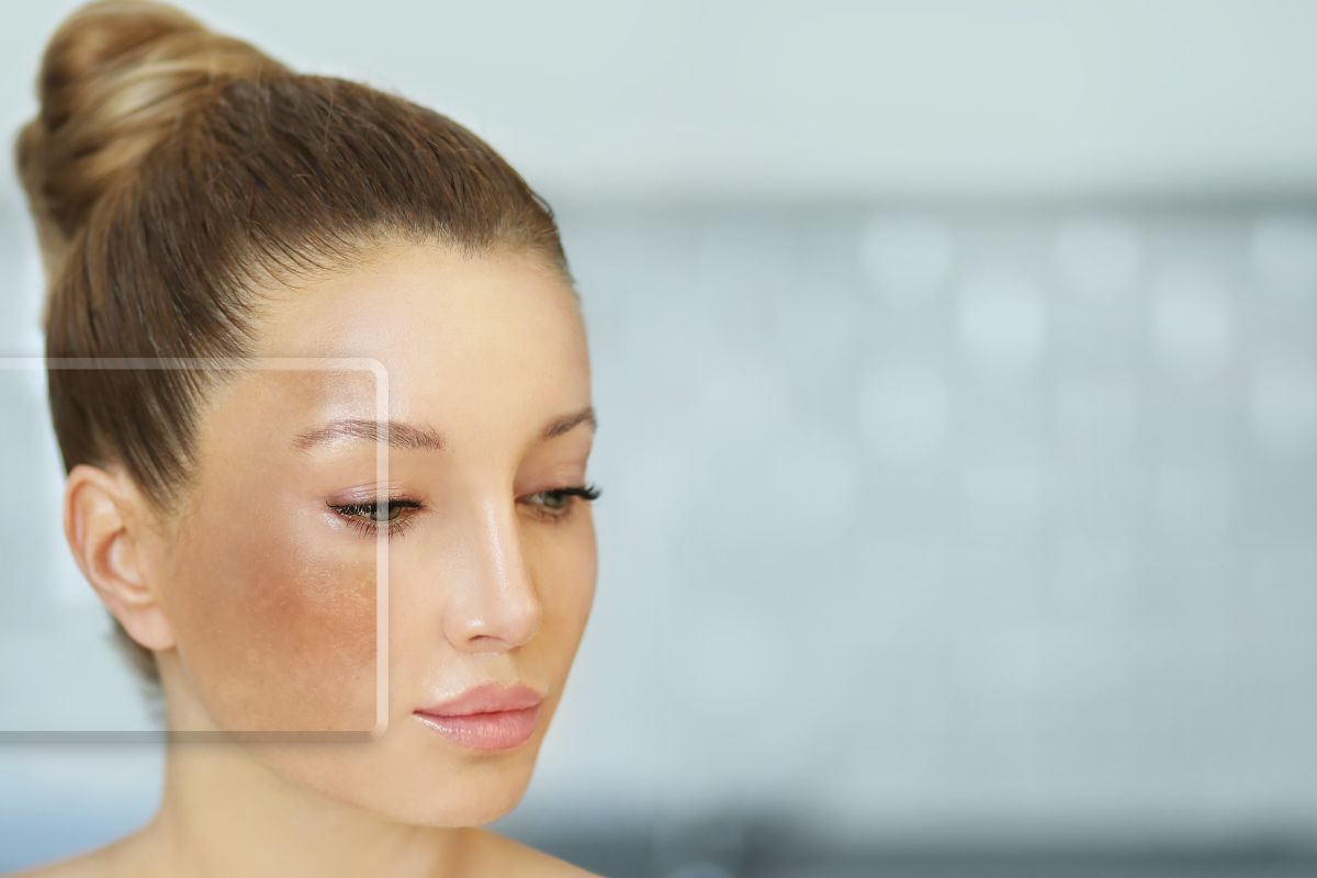 Lee más sobre el artículo Tratamiento de melasma en Santander